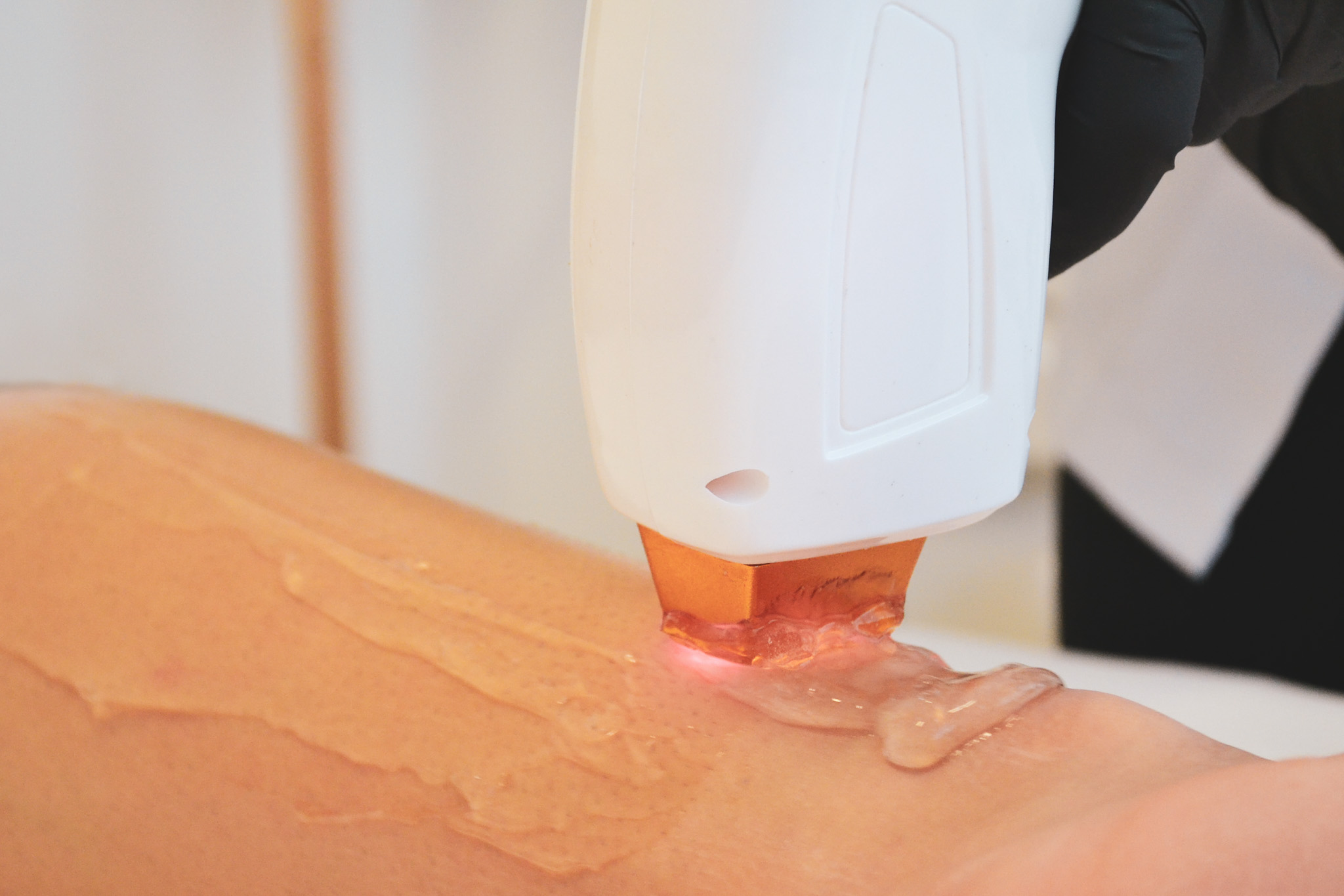 Depilação a Laser, com laser diodo 3 ondas, Alexandrite, Diodo, YAG, para todos os tipos de pele incluindo peles bronzeadas e indolor na Clínica Conceito do Corpo - Estética e Saúde em Paredes.