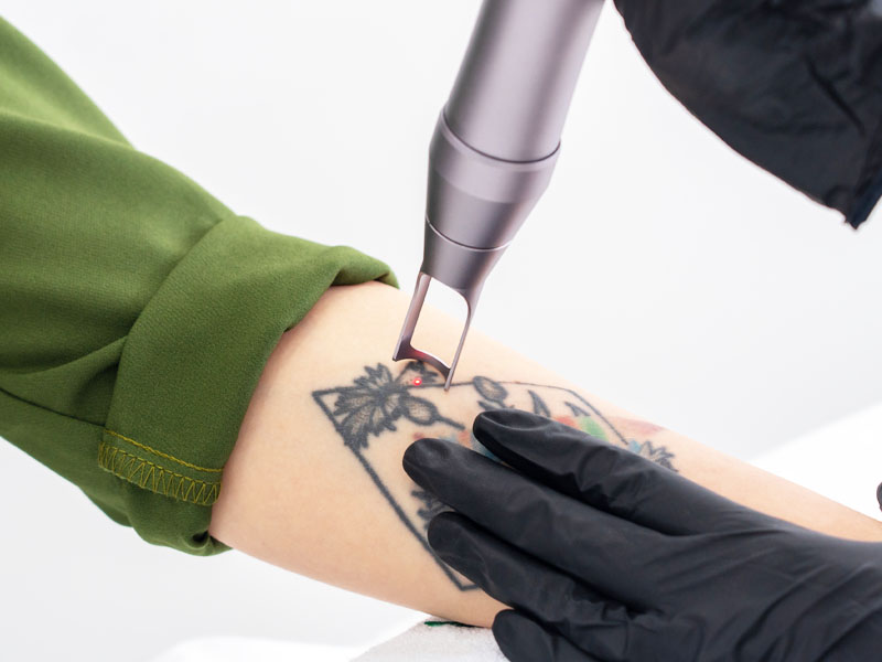 Laser nd:YAG utilizado para cremoção de tatuagem e micropigmentação de sobrancelha na Clínica Conceito do Corpo em Paredes